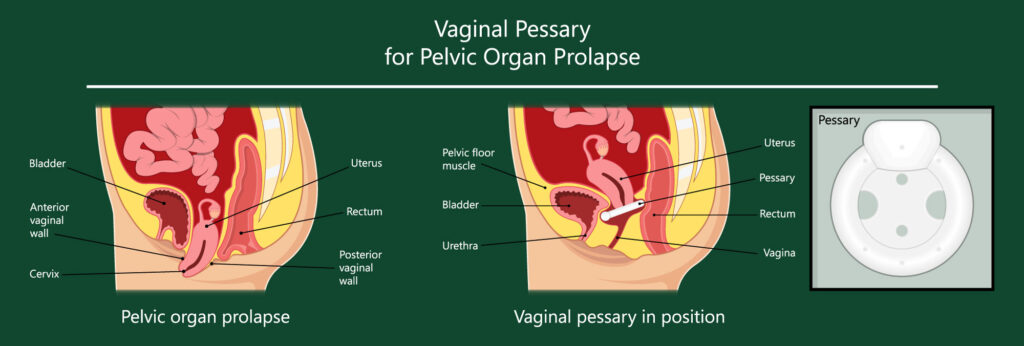 Pessary-Fitting