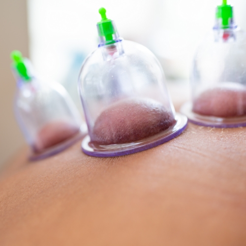 cupping-therapy-The-Physio-Care-Okotoks-AB