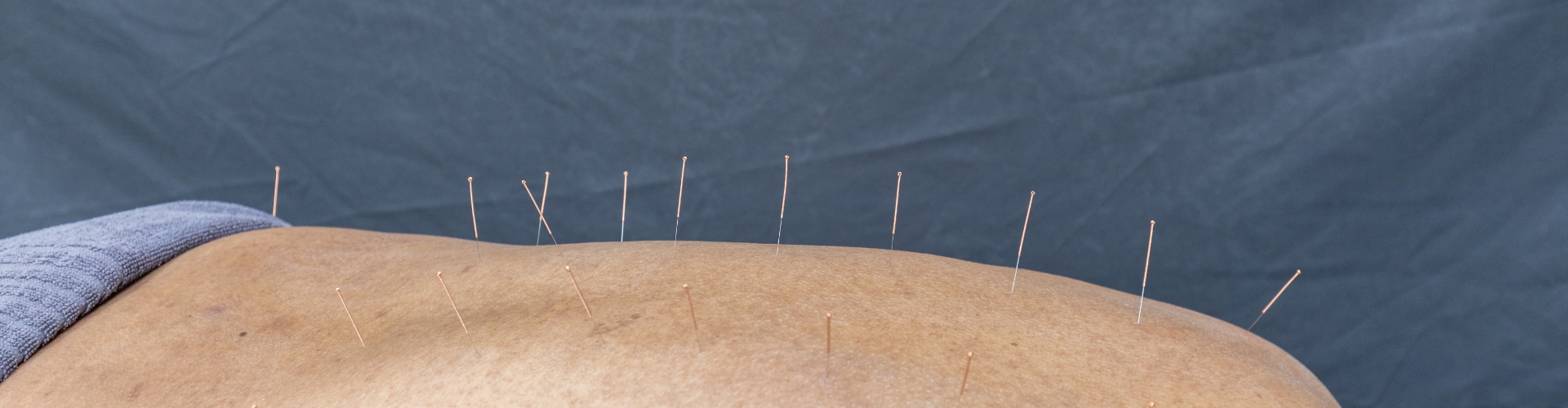 Dry Needling/Gunn IMS